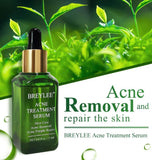 Acne Treatment Serum Facial Essence Repair Oil - Nioor