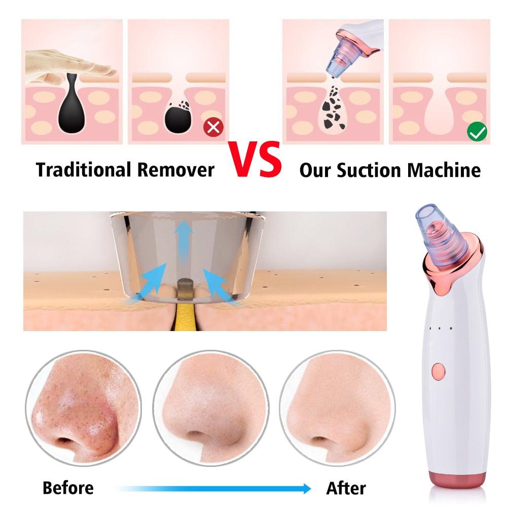 Blackhead Instrument Electric Suction Facial Washing Instrument Beauty Acne Cleaning Blackhead Suction Instrument - Nioor